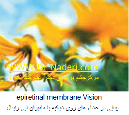 epiretinal membrane Vision بینایی در غشاء های روی شبکیه یا مامبران اپی رتینال 